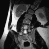 Motion MRI